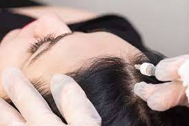 How to Prepare for DHI Hair Implantation in Dubai.