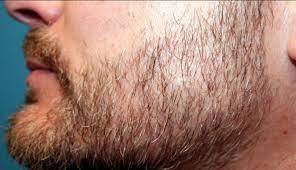 Beard Hair Transplant in Dubai6.jpg