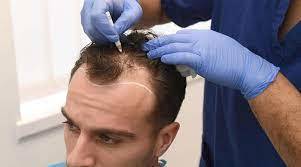 Stem Cell Fue Hair Transplant Dubai16.jpg