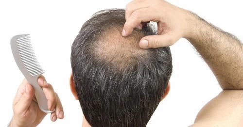 Hair Transplant Cost in Dubai9.jpg