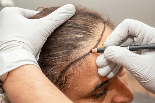 FUE Hair Transplant in Dubai10.jpg