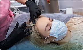 Unbelievable Deal Get a Hair Transplant in Dubai f