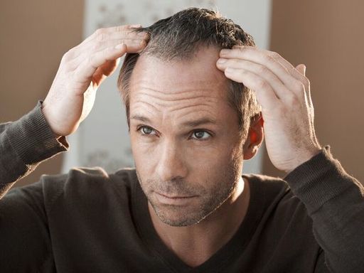 Say Goodbye to Baldness FUE Hair Transplant in Dub